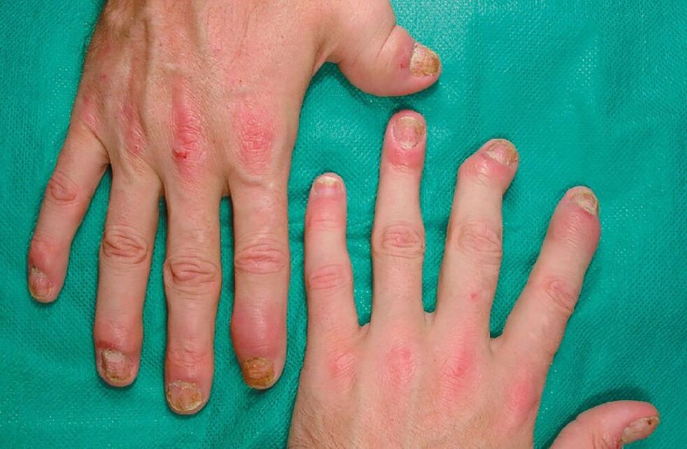 алергія пры паразітах у арганізме